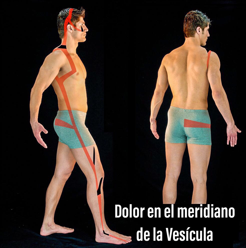 Tratamiento de acupuntura para dolor de cuello y hombro